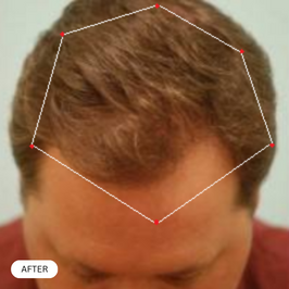 Picture of male pattern baldness after taking Revifol for hair loss