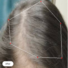 Picture of scalp of female after taking Revifol for 6 months.