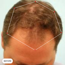 Picture of male pattern baldness before taking Revifol for hair loss.