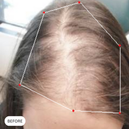 Picture of scalp of female before taking Revifol.